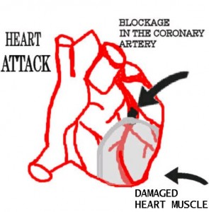 heart-attack heart-attack
